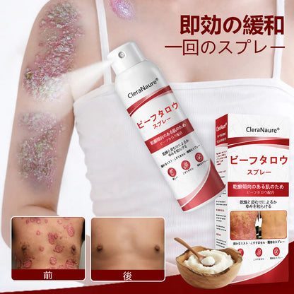CleraNaure® ビーフタロウスプレー — かゆみ・皮膚の剥がれを抑える乾癬用スキンケアスプレー🥇