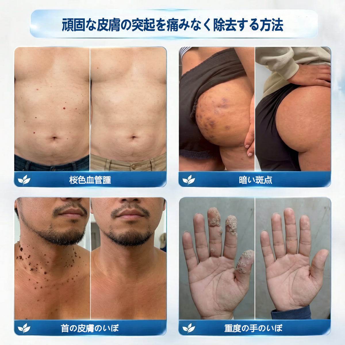 公式ストア🎉7日間スポット＆シミ除去ケア （ゼロ痛み・ゼロダメージ ローラーボール）🛡️🛡️🛡️