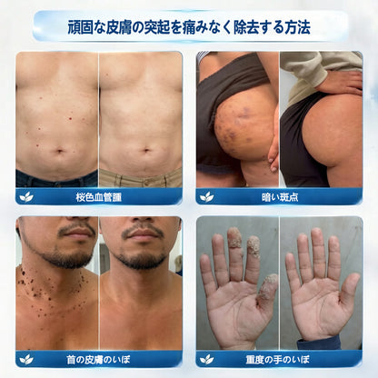 公式ストア🎉7日間スポット＆シミ除去ケア （ゼロ痛み・ゼロダメージ ローラーボール）🛡️🛡️🛡️