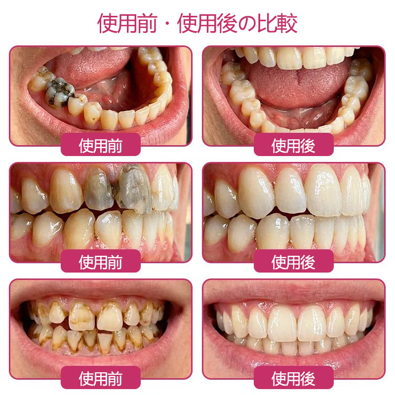 CleraNaure® DenPerm エナメル質修復フィリングジェル🦷🧡