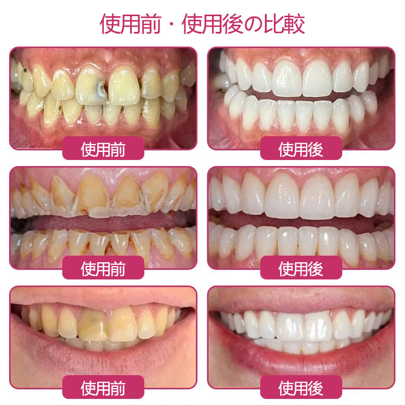 CleraNaure® DenPerm エナメル質修復フィリングジェル🦷🧡