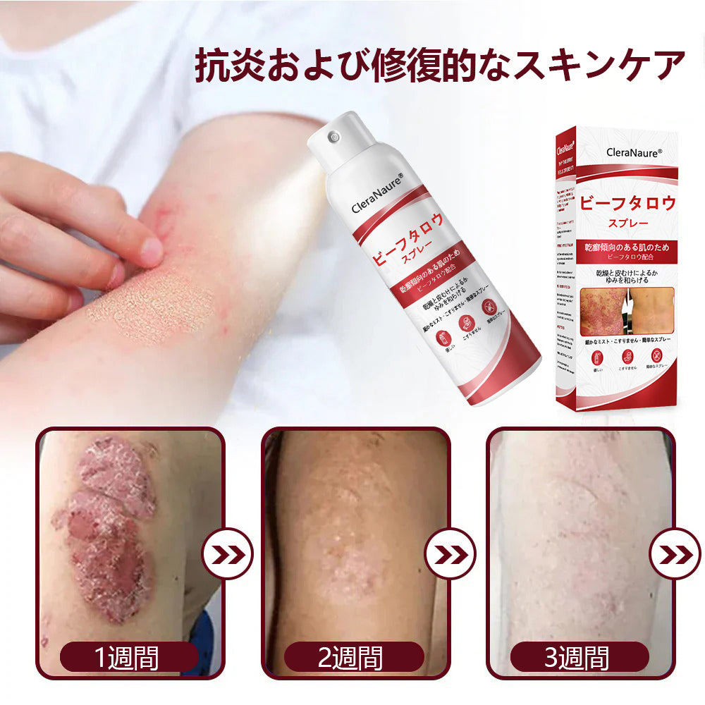 CleraNaure® ビーフタロウスプレー — かゆみ・皮膚の剥がれを抑える乾癬用スキンケアスプレー🥇